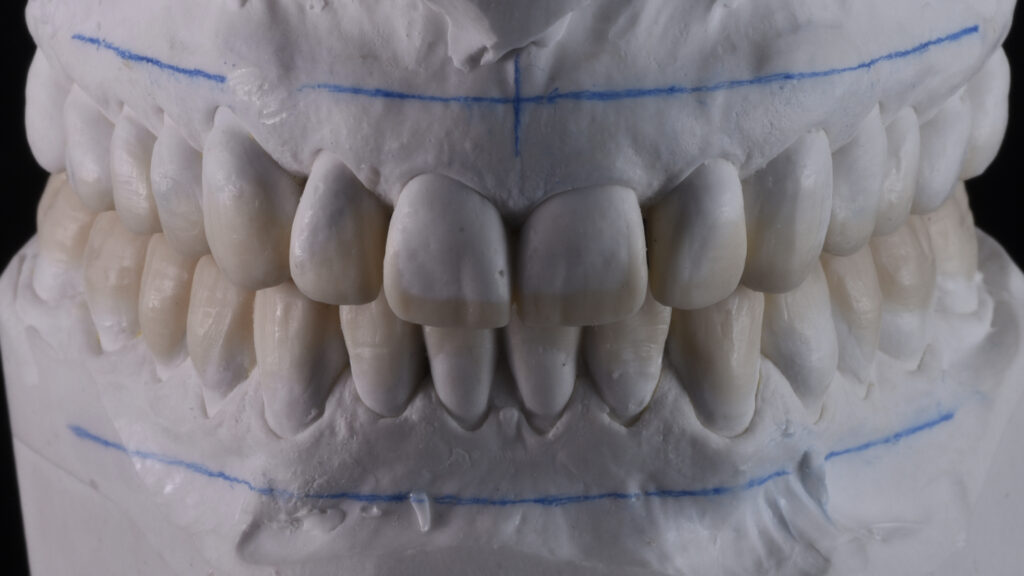Wax-up