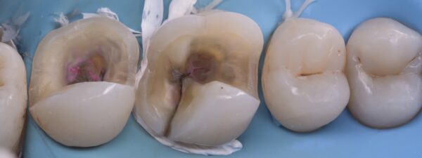 Indirect bonded restorations